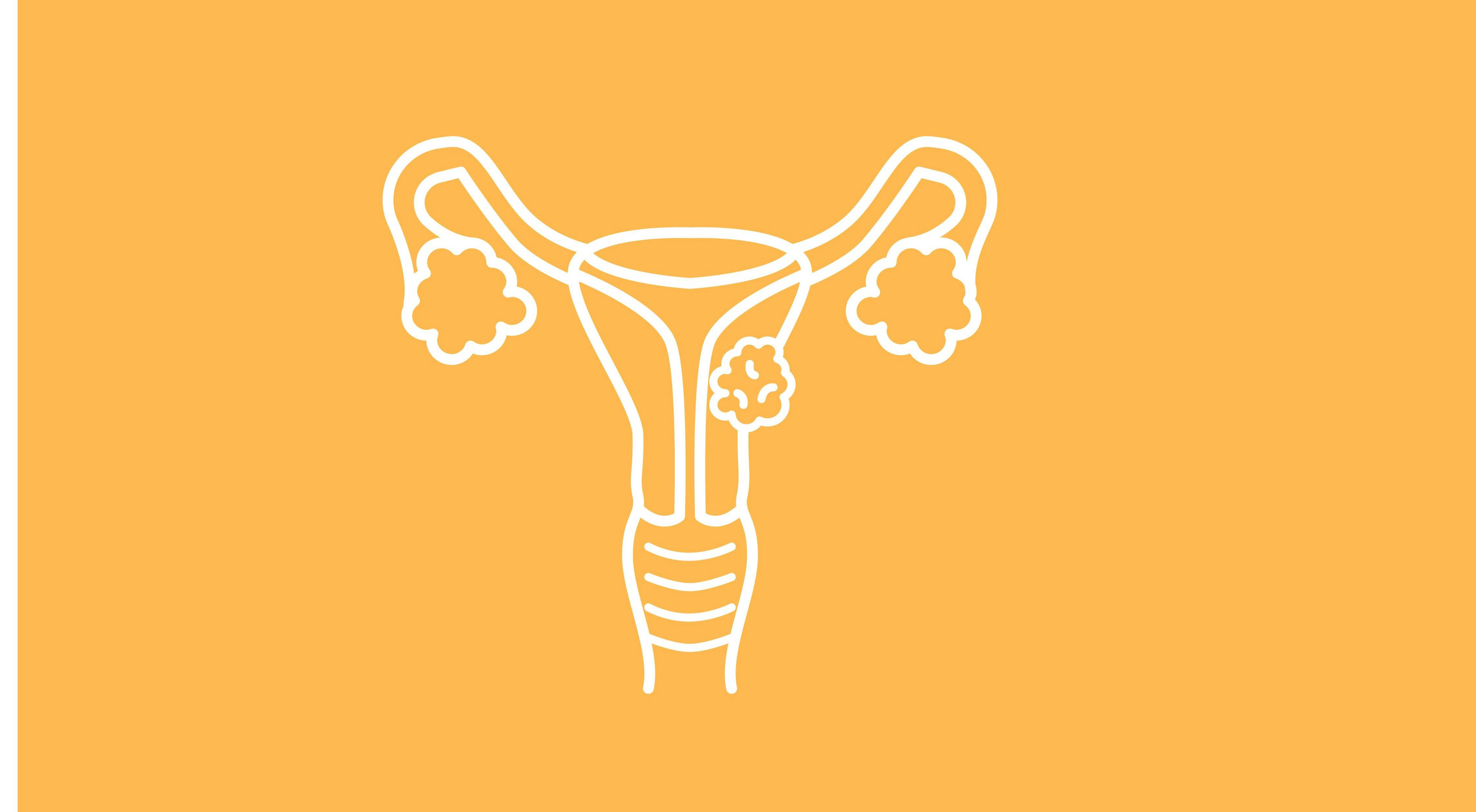 Niraparib Shows Durable Responses in Recurrent Ovarian Cancer Regardless of BRCA Mutation