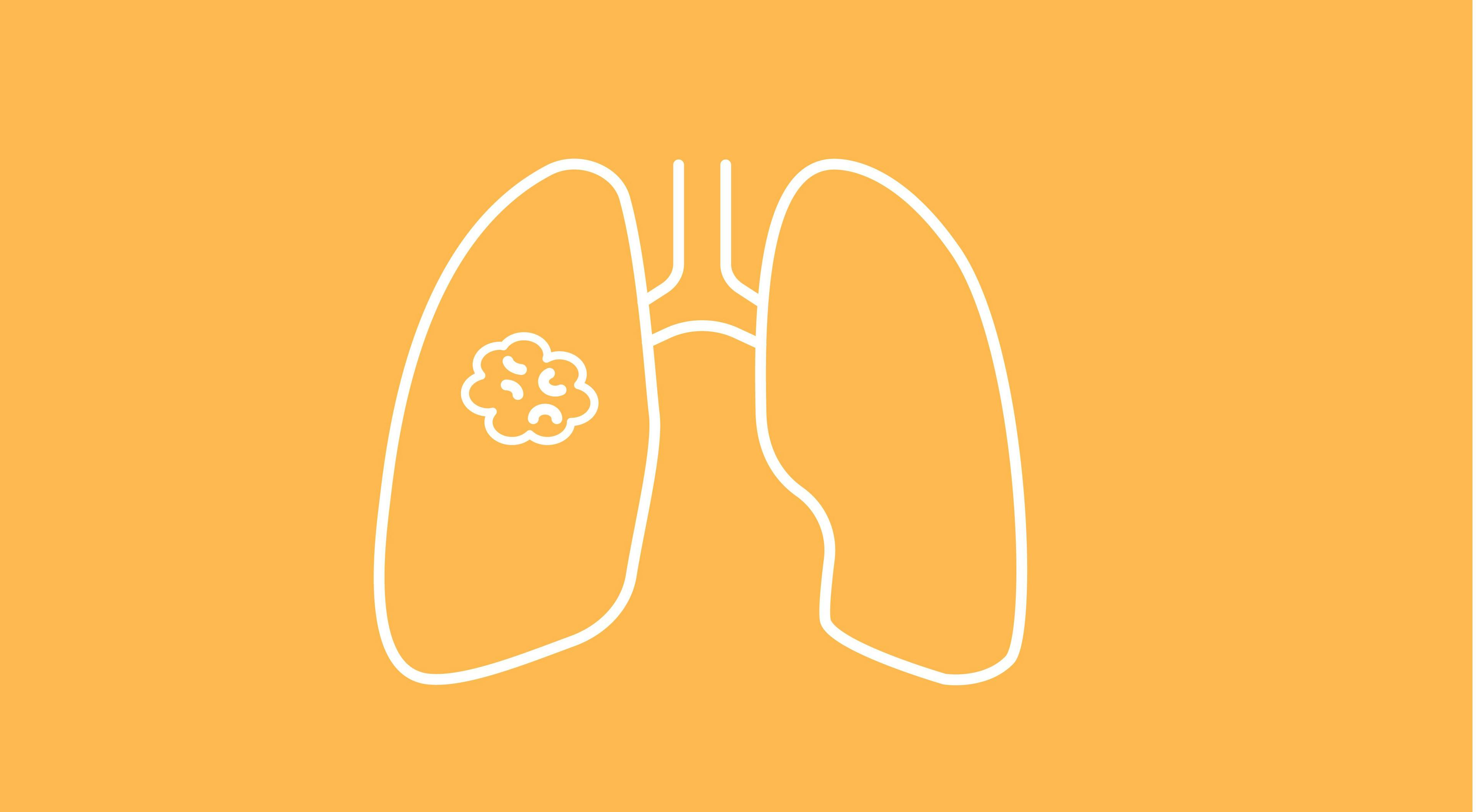 Study Identifies High Mortality Rates in Patients with COVID-19 and Malignant Pleural Mesothelioma