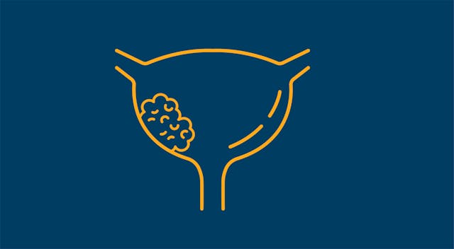 Sacituzumab Govitecan Yields ‘Limited Efficacy’ in Previously Treated Metastatic Urothelial Carcinoma