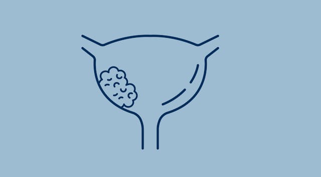 Enfortumab Vedotin Plus Pembrolizumab May Not Negatively Affect Quality of Life in Metastatic Urothelial Cancer