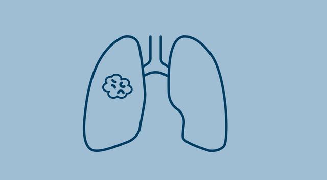 Two Phase 3 Trials of Pembrolizumab in NSCLC, CSCC to Be Discontinued By Merck